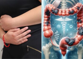 Día Mundial del Cáncer de Colon: Prevención y detección oportuna