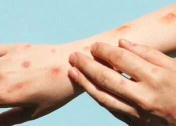 Hidalgo refuerza vigilancia ante nueva variante de viruela del mono