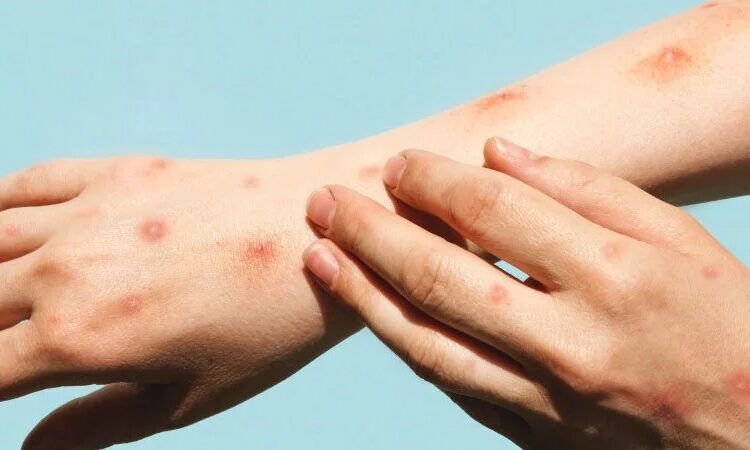 Hidalgo refuerza vigilancia ante nueva variante de viruela del mono